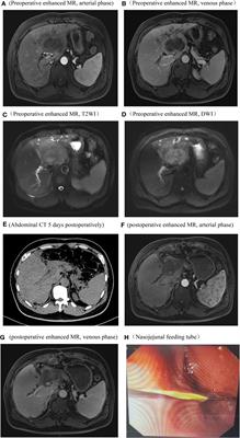 Primary hepatic adenosquamous carcinoma: a case report and review of the literature